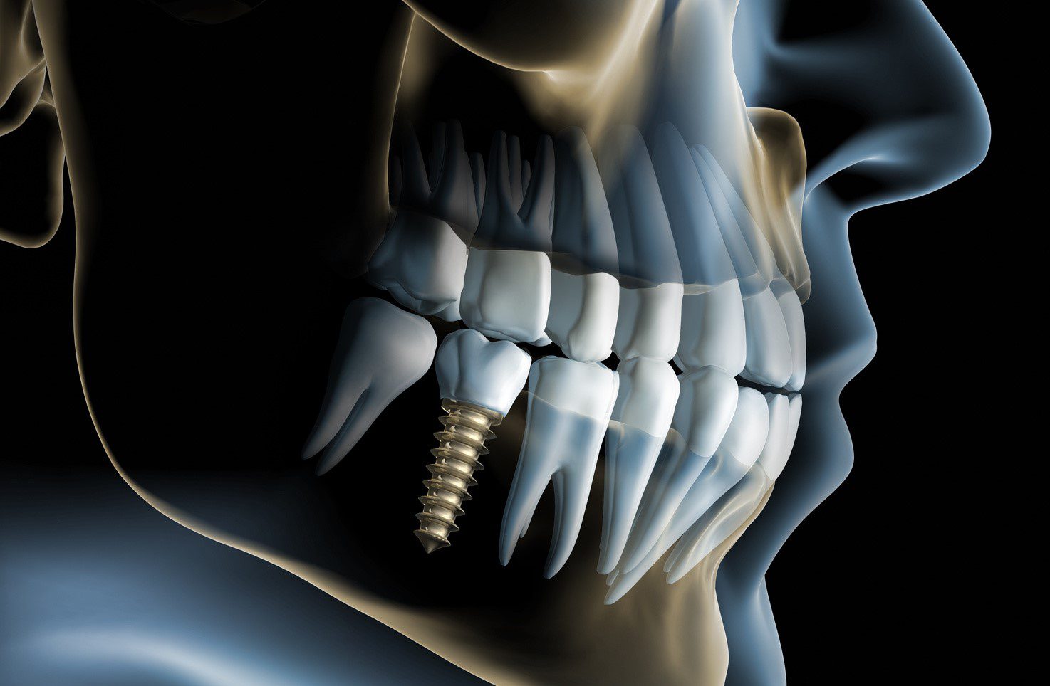 dental implant surgery image