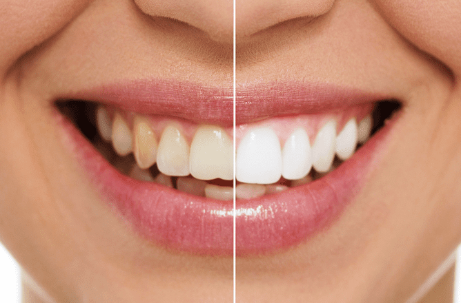 teeth-whitening-image